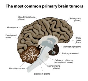 Types of Brain Tumors