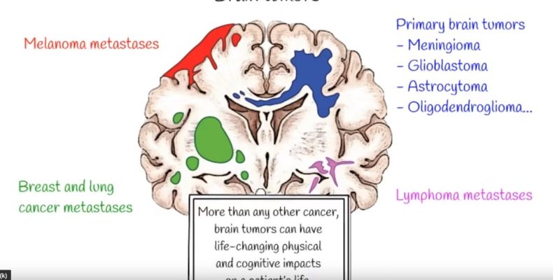 How does solid stress from brain tumors damage healthy tissue?